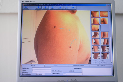 Das Program FotoFinder Dermoscope 2 zur Erkennung von Hautkrebs läuft auf einem PC